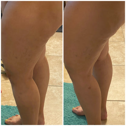 Anti-Cellulit Massage