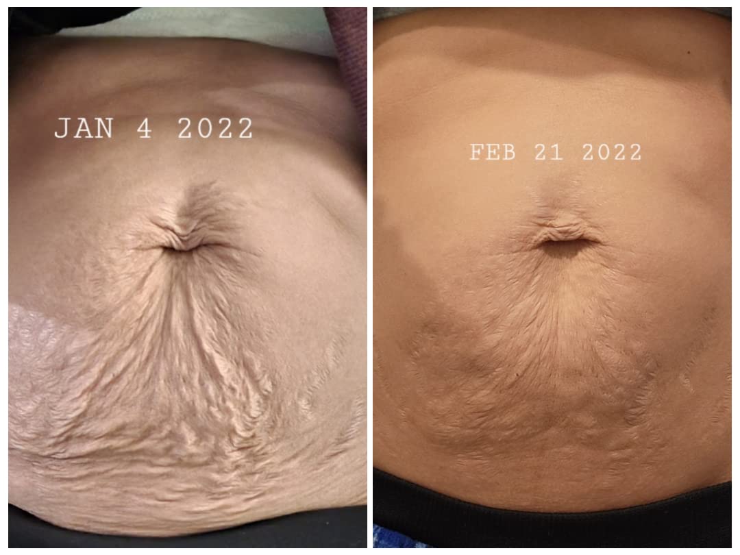 Anti-Cellulit Massage