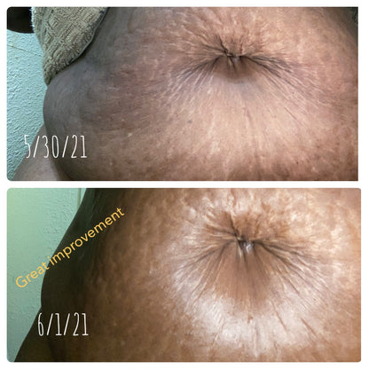 Anti-Cellulit Massage