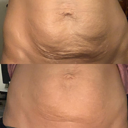 Anti-Cellulit Massage