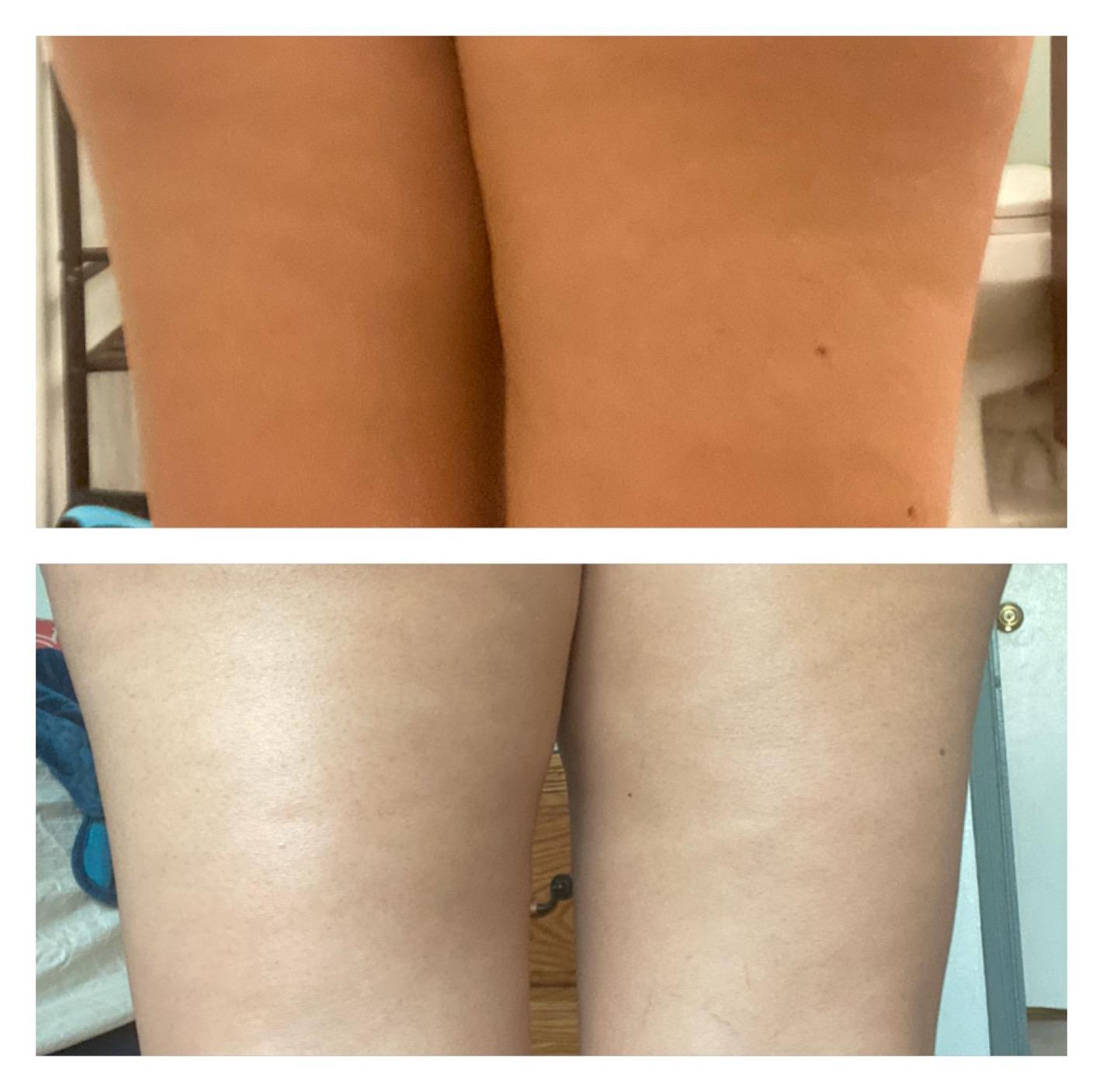 Anti-Cellulit Massage