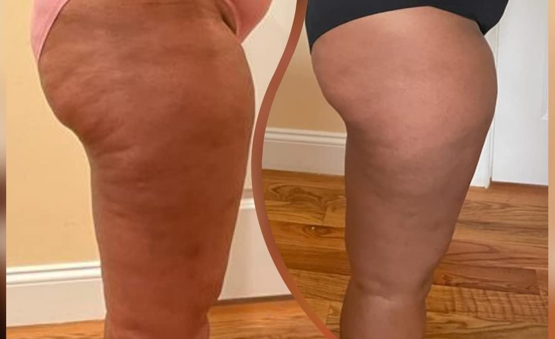 Anti-Cellulit Massage