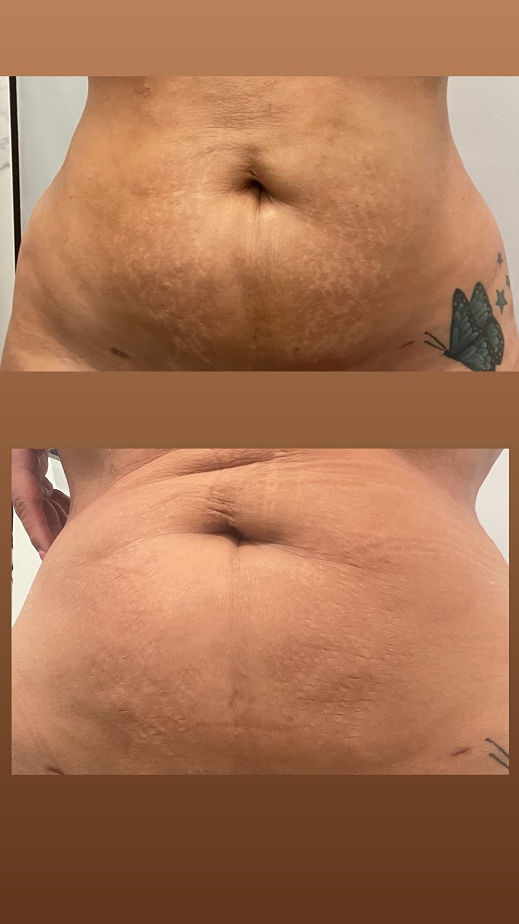 Anti-Cellulit Massage