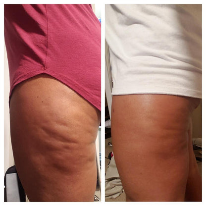 Anti-Cellulit Massage
